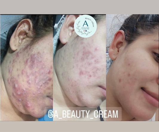 crema de ACNE